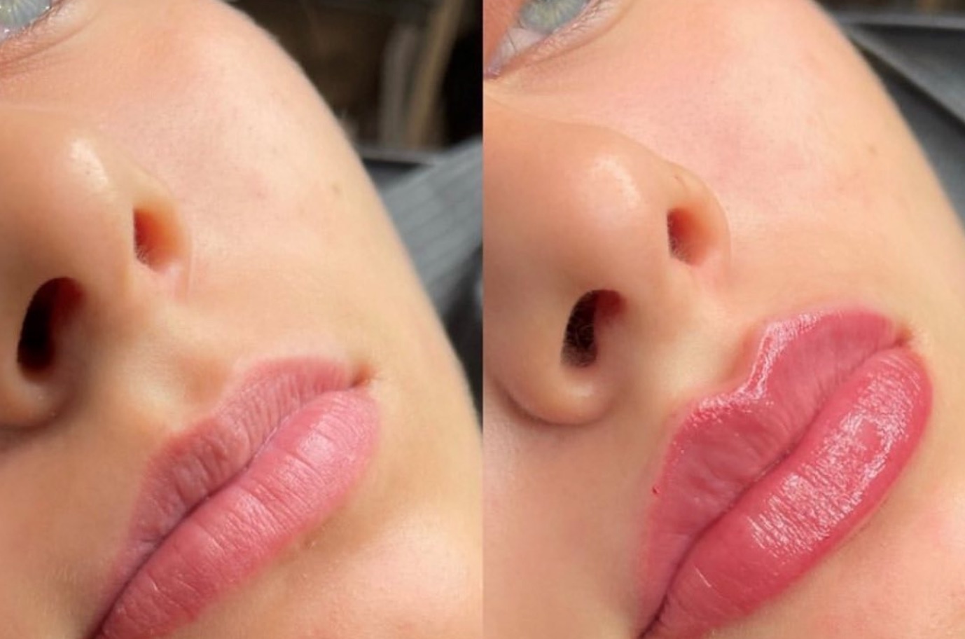 Before and after lip filler: fuller, more defined lips shown from a side angle