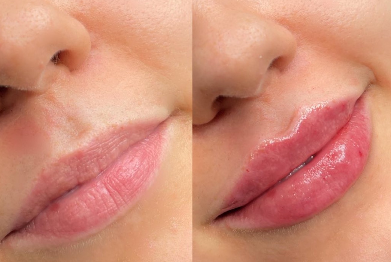 Before and after lip filler: increased volume and a more defined lip border