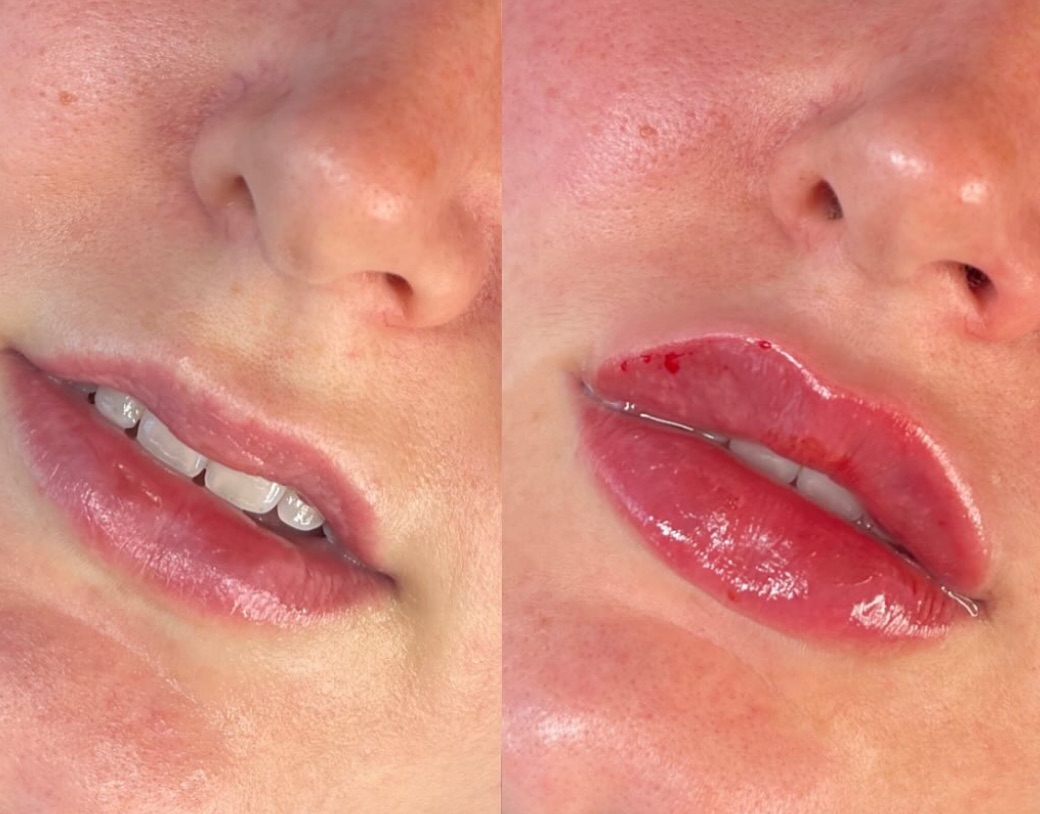 Before and after lip filler: fuller upper and lower lips immediately after treatment